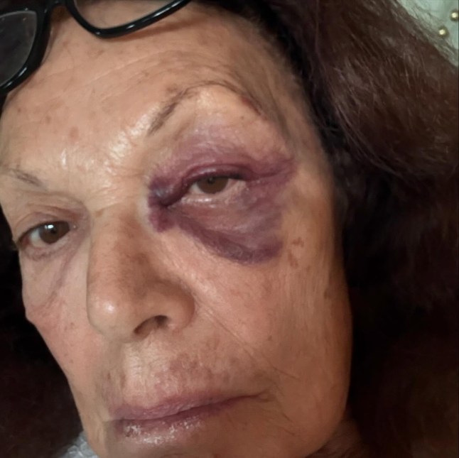 Upon arrival in LA, I fell on the pavement and hit my forehead ! Does not look good for sure but grateful nothing more serious !!! I am owning it, applying lots of arnica gel and happy it was not worse !! Owning it is the secret of survival !