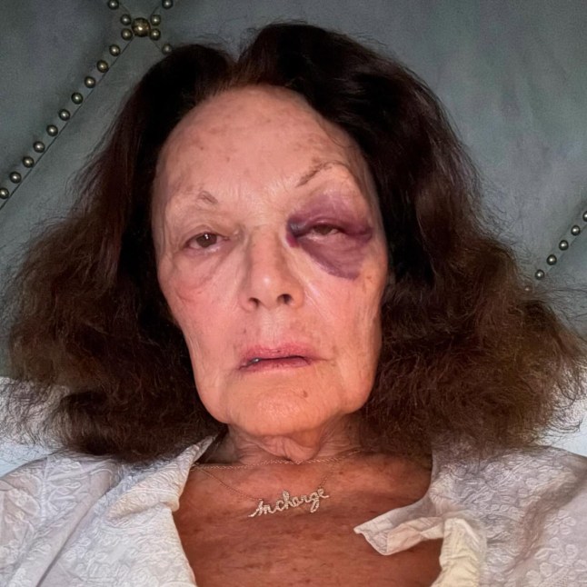 Upon arrival in LA, I fell on the pavement and hit my forehead ! Does not look good for sure but grateful nothing more serious !!! I am owning it, applying lots of arnica gel and happy it was not worse !! Owning it is the secret of survival !