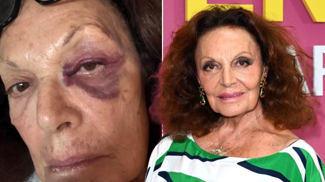 A compilation picture with left image of Diane von Furstenberg sharing a close up photo of black eye. Right picture shows her smiling, without black eye.