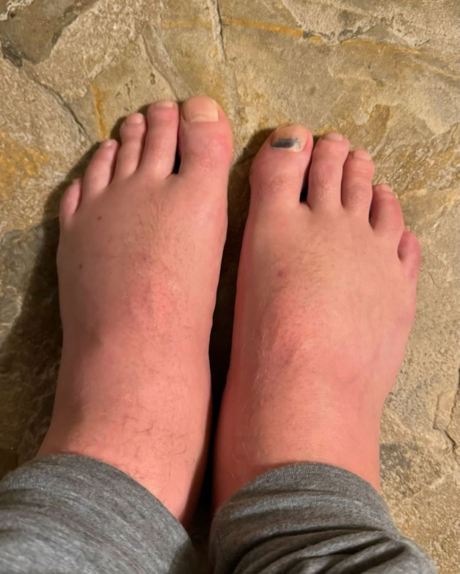 Jamie Laing reveals painful injury to penis after gruelling ?2,000,000 marathon https://www.instagram.com/p/DHkz8jksPsm/?hl=en-gb